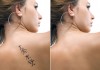 tattoo-verwijderen
